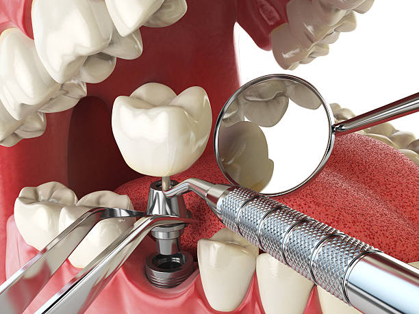 Best Emergency Dental Surgery in Bushnell, IL